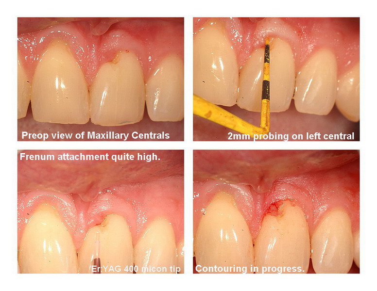 Frenectomy Pg 1 edited_resize.jpg